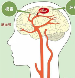 防止脑血栓形成要注意6种生活方式