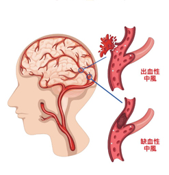 龚洪海博士：注意中风四大征兆
