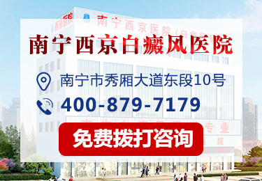 南宁白癜风治疗哪里医院好